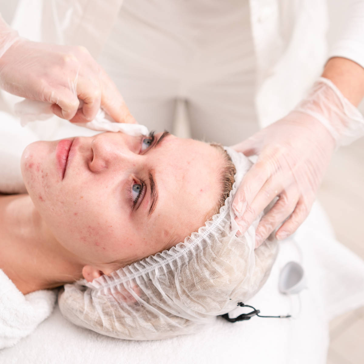 Anti acne phototherapy