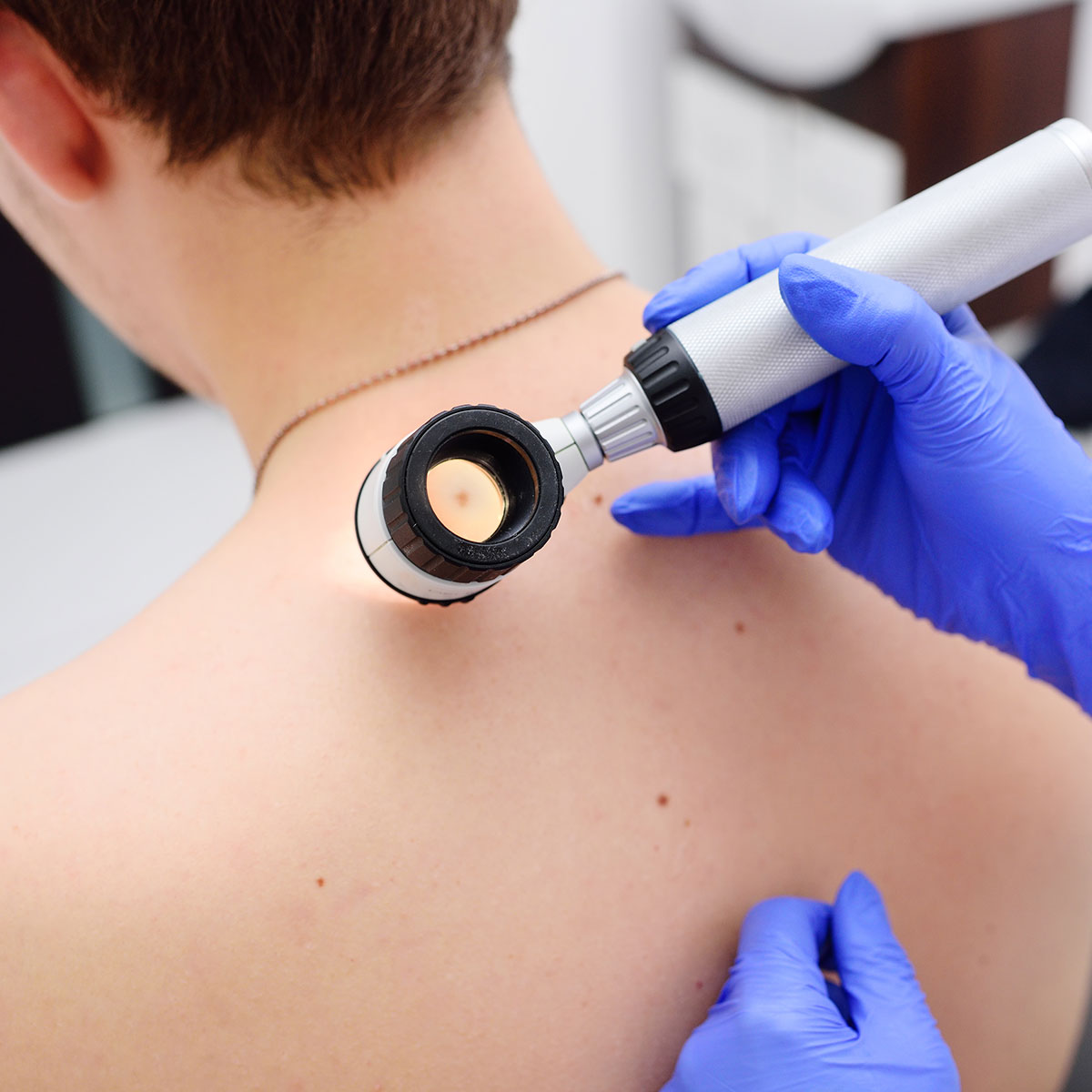 Dermatologist examining birthmarks and moles on a female patient